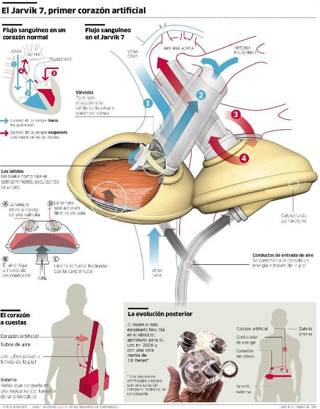 Jarvik 7, the first artificial heart